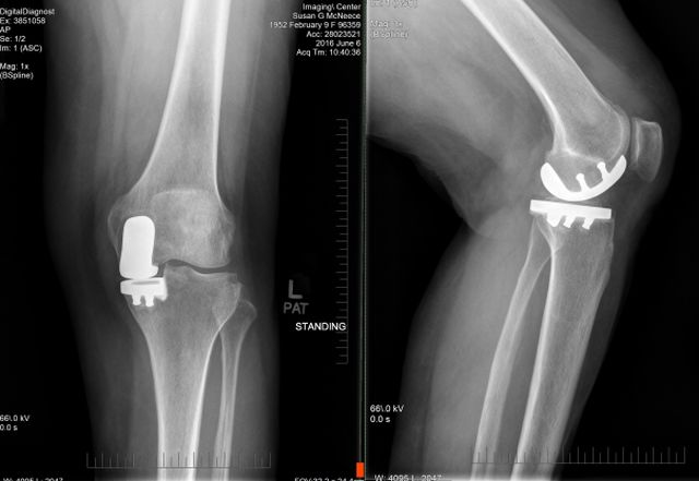 SGM Left Knee SGM Left Knee