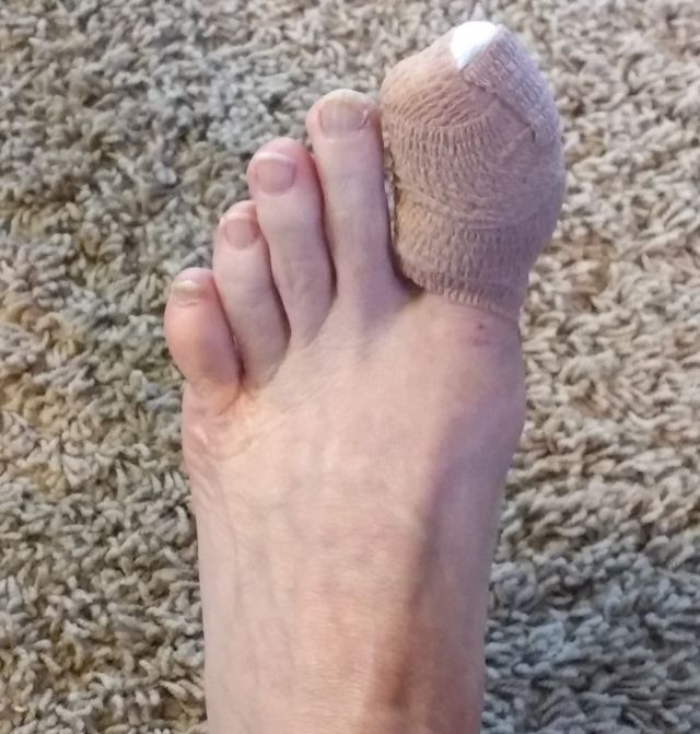 Ingrown toenail Ingrown toenail