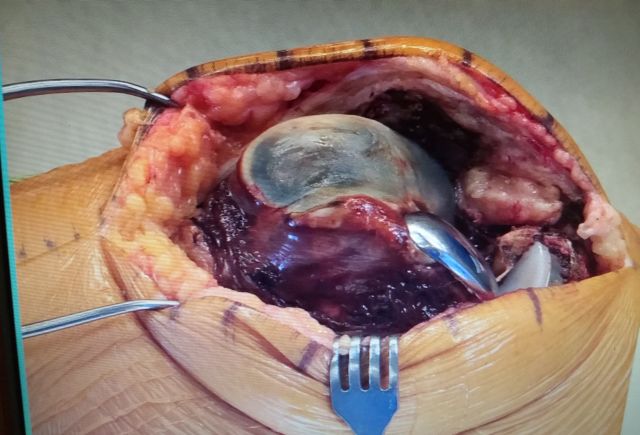 Insides of knee Insides of knee