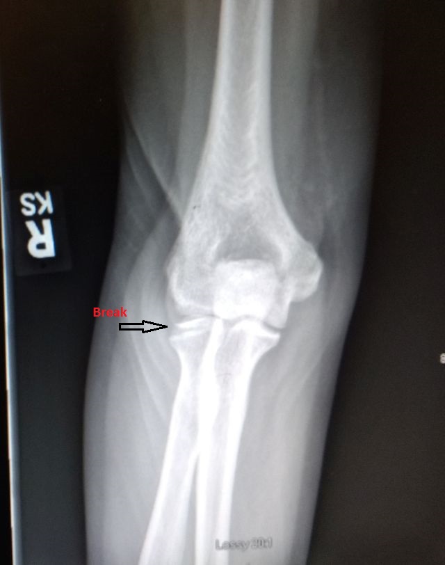 Elbow Elbow