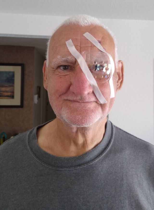 Jim cataract Jim cataract