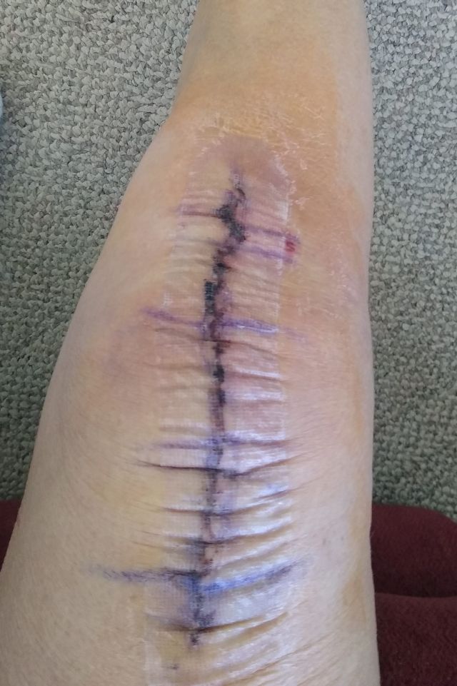 Inner bandage Inner bandage