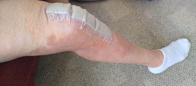 Outer bandage Outer bandage