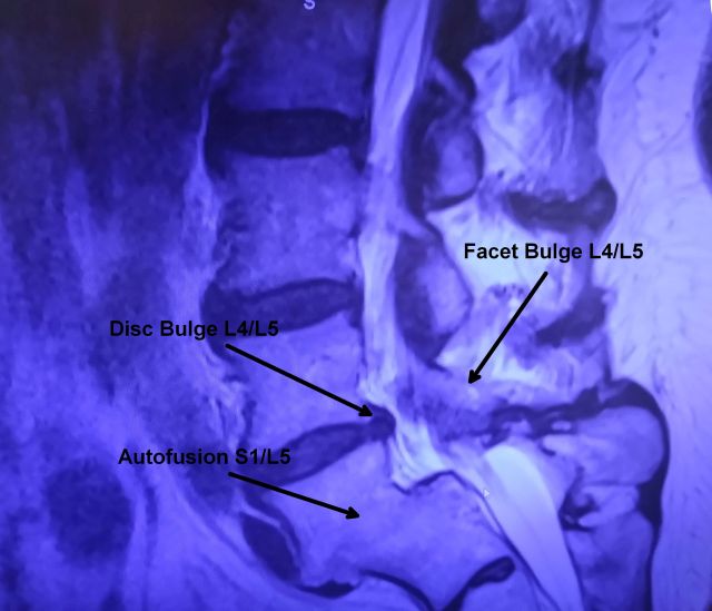 Spine MRI Spine MRI