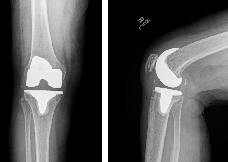 Right knee xray Right knee xray