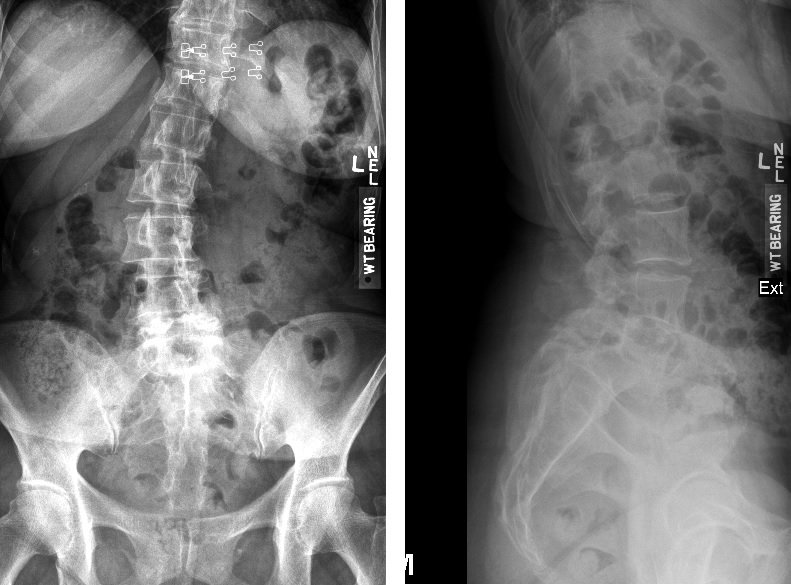 Back xray Back xray